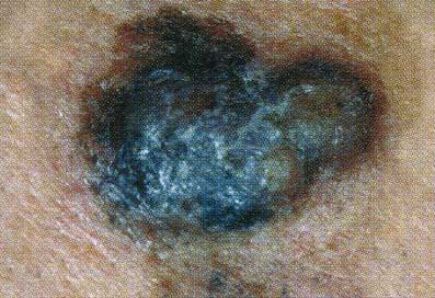 Nodular melanoma