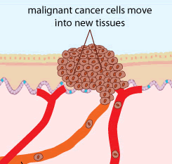 Malignant cancer cells