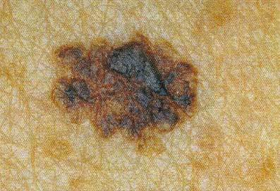 Melanoma