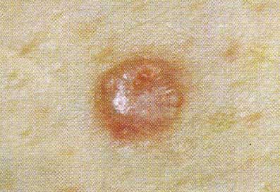 Basal cell carcinoma